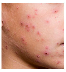 Chicken Pox