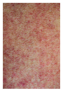 Dengue Rash