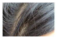 Head Lice