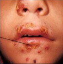 Impetigo